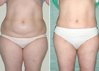 吸脂减肥前后对比