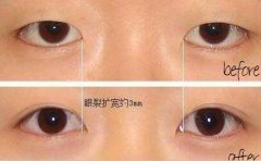 埋线双眼皮的价格和什么因素有关？为什么价格差异这么大？