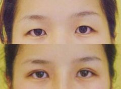 北京做埋线双眼皮价格多少？价格受到哪些因素影响？
