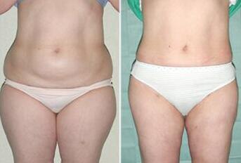 吸脂减肥前后对比照