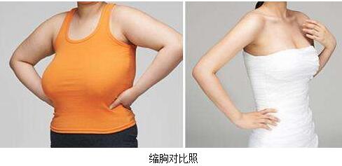 巨乳如何缩小？巨大乳房缩小需要注意什么？