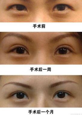 肿眼泡做双眼皮成好吗?肿泡眼如何做双眼皮?