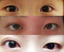 眼睛是单双眼，做一只眼睛的双眼皮手术行不行？
