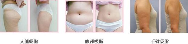 吸脂前后对比照