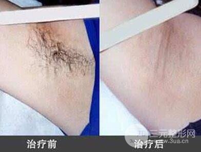 狐臭怎么办?狐臭比较好缓解方案是什么?狐臭手术果和过程