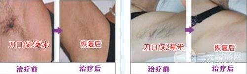 狐臭能被吗?狐臭喜欢的缓解方法?狐臭手术后会不会留疤痕?