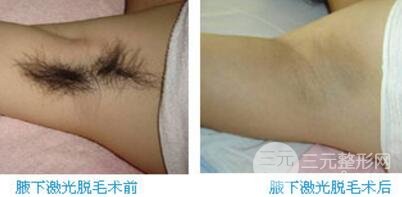 狐臭能被吗?狐臭喜欢的缓解方法?狐臭手术后会不会留疤痕?