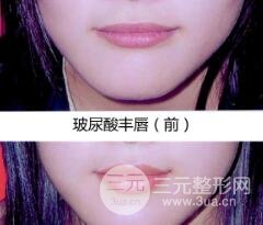 嘴唇薄可分丰唇,丰唇有哪些方法?丰唇前后对比果图 嘴唇薄可分丰唇,丰唇有哪些方法?丰唇前后对比果图