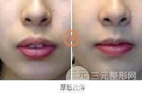 嘴唇改薄