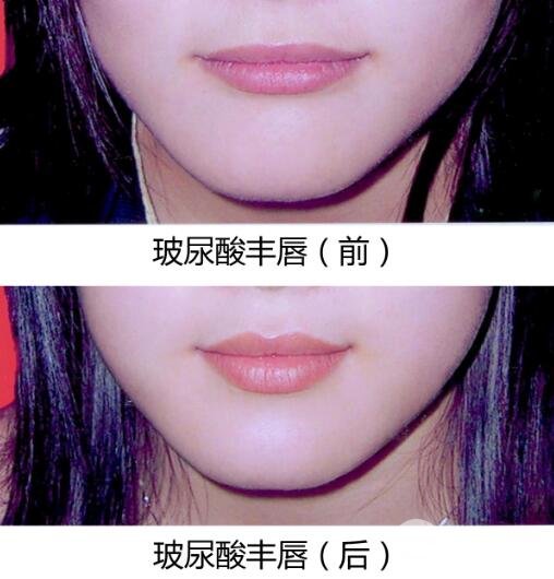 玻尿酸丰唇