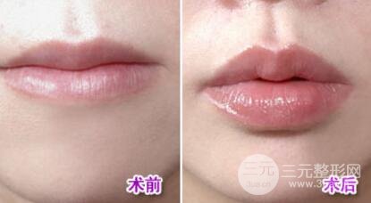 胶原蛋白丰唇果持久吗?胶原蛋白丰唇图片