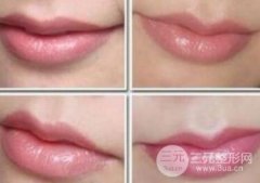 玻尿酸丰唇果好不好?会出现凹凸不平情况吗 玻尿酸丰唇果好不好?会出现凹凸不平情况吗