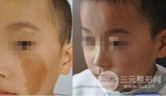 激光去胎记哪家医院好?激光去胎记成好吗?前后对比图 激光去胎记哪家医院好?激光去胎记成好吗?前后对比图