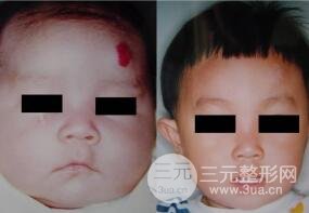 怎么去胎记?激光去胎记好吗?价格多少?激光去胎记果图 怎么去胎记?激光去胎记好吗?价格多少?激光去胎记果图
