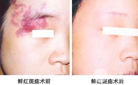 去胎记喜欢的办法?激光去胎记后会复发吗?激光去胎记原理