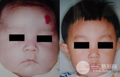 激光去胎记能去干净吗？会不会留疤？