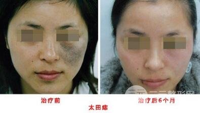 激光去胎记安不降低风险呢?激光去胎记能去干净吗?