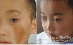 如何去除面部的胎记?