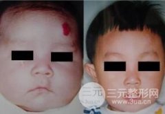 激光去胎记哪家好?