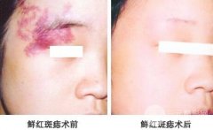 激光去胎记要多少钱?