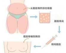 自体脂肪移植隆胸术好吗?术前要注意哪些?丰胸过程 自体脂肪移植隆胸术好吗?术前要注意哪些?丰胸过程