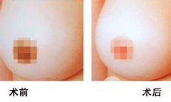 乳晕漂红做一次就行吗? 乳晕漂红做一次就行吗?