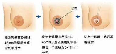 乳晕缩小手术会有疤痕吗?