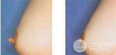 乳头缩小手术副作用大吗? 乳头缩小手术副作用大吗?