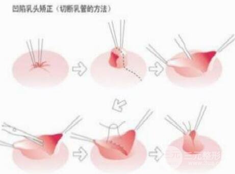 乳头凹陷矫正术后护理该怎样做?