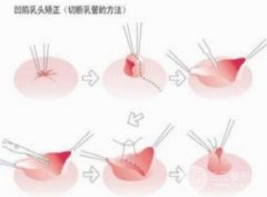 乳头内陷矫正后能正常哺乳吗? 乳头内陷矫正后能正常哺乳吗?