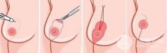 乳房下垂矫正后还会下垂松弛吗? 乳房下垂矫正后还会下垂松弛吗?