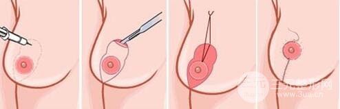 乳房下垂矫正后还会下垂松弛吗?