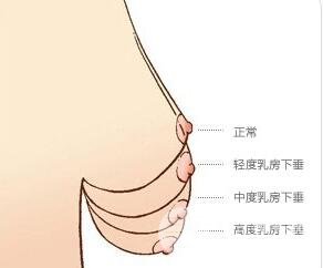 乳房下垂矫正 恢复女性魅力