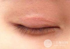 割双眼皮整形有什么后遗症？割双眼皮长肉条怎么办？