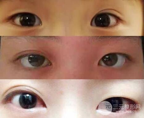 单双眼皮可以做双眼皮吗?