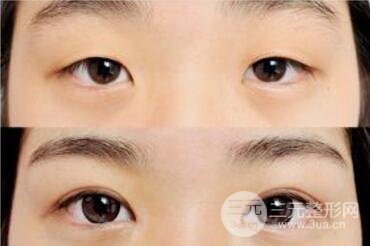 双眼皮手术果能保持多久?