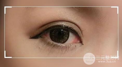 四十岁适合割双眼皮吗?