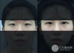 割双眼皮后不对称是否是失败?