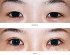 近视可以做割双眼皮整形吗？影响割双眼皮的果吗?割双眼皮价格