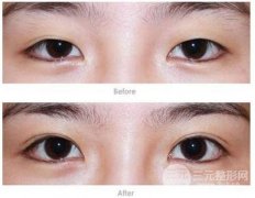 哪些人适合做双眼皮?什么时候做双眼皮更容易恢复?