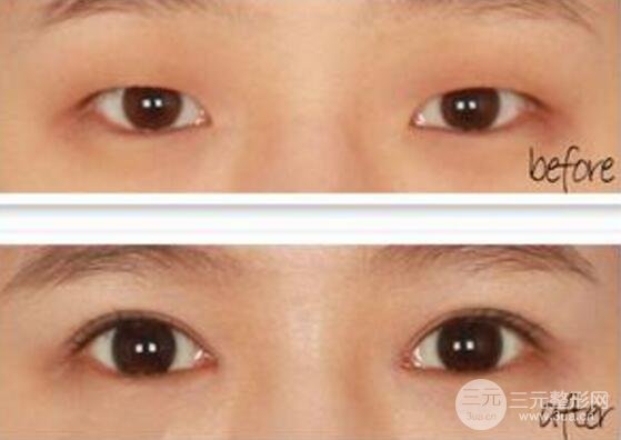 割双眼皮后注意事项，吃什么水果好？