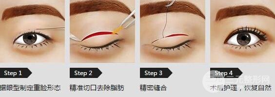 切开双眼皮好还是埋线双眼皮哪个好？各有什么优缺点，该如何选择？