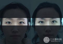 切开双眼皮术后怎么护理，需要冰敷吗？