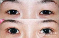 割双眼皮适合多大年纪呢？