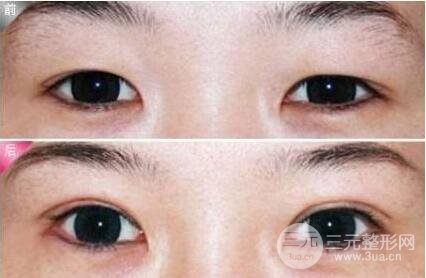 割双眼皮适合多大年纪呢？