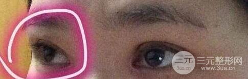 开眼角失败了怎么办?