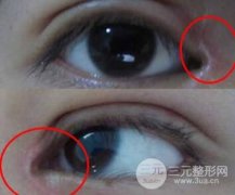 开眼角出现疤痕增生咋办？