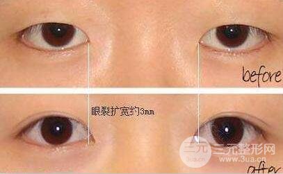 开眼角前后对比图 开眼角后遗症 开眼角的风险
