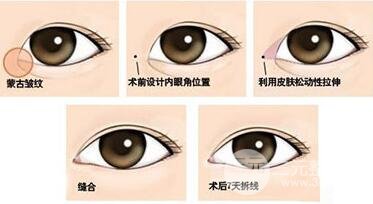 怎么知道自己适不适合开眼角？什么人适合开眼角？
