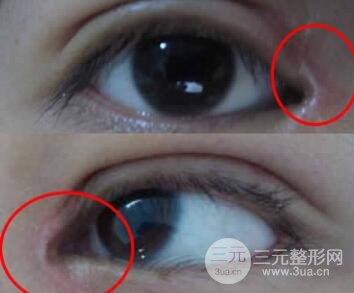 开内眼角有增生怎么办?